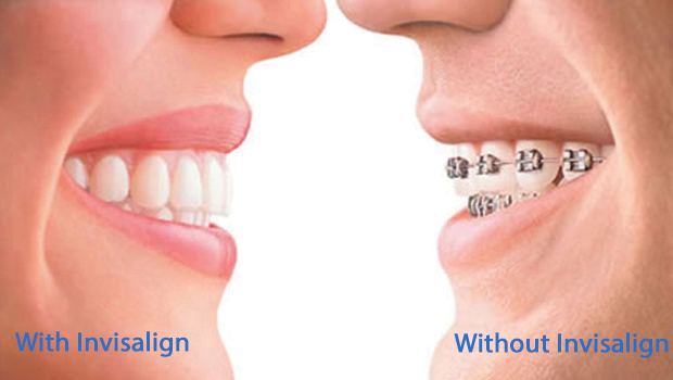 Invisalign in Hamilton Township